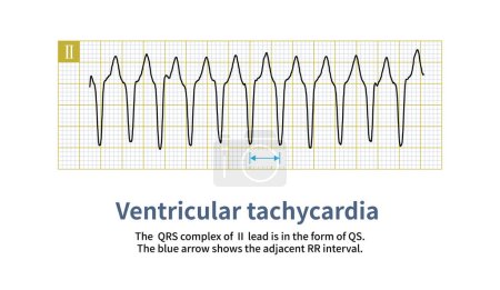 Foto de La onda QRS de la taquicardia ventricular puede ser una onda QRS ancha o una onda QRS estrecha, que depende del lugar de origen y de la secuencia de activación de la taquicardia ventricular en el ventrículo.. - Imagen libre de derechos