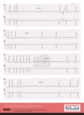 Téléchargez les photos : After the paroxysmal atrial fibrillation attack stopped, there was a long period of sinus arrest and sinus bradycardia. This phenomenon suggests sick sinus syndrome. - en image libre de droit