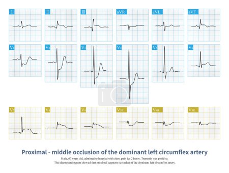 Téléchargez les photos : The proximal segment occlusion of the dominant left circumflex artery can lead to multiple myocardial infarction, including left ventricular lateral,posterior and inferior wall. - en image libre de droit