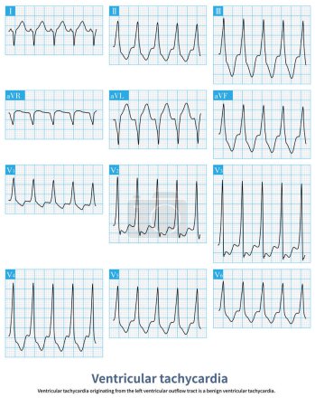Photo for Ventricular tachycardia originating from the left ventricular outflow tract is a benign ventricular tachycardia.It usually does not cause sudden death.Radiofrequency ablation can cure this arrhythmia. - Royalty Free Image