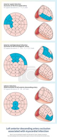 Foto de La oclusión de la arteria descendente anterior izquierda en diferentes partes causa diferentes rangos de infarto del ventrículo izquierdo y diferentes cambios en el ECG. - Imagen libre de derechos