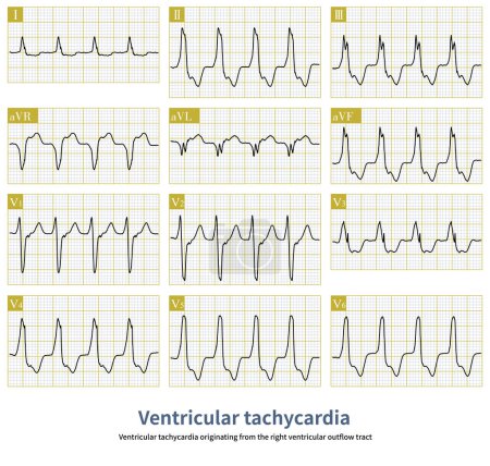 Téléchargez les photos : Ventricular tachycardia originating from the right ventricular outflow tract is a benign ventricular tachycardia.It usually does not cause sudden death.Radiofrequency ablation can cure this arrhythmia. - en image libre de droit