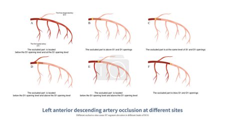 Photo for When different parts of the left anterior descending artery are occluded, the distribution of ST segment elevation leads in ECG is different, so the occluded part can be deduced. - Royalty Free Image