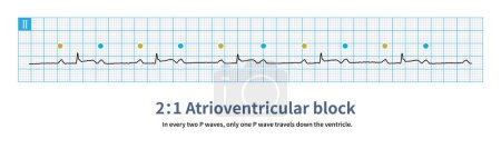 Photo for The sinus P wave marked by the yellow circle passes down the ventricle, and the sinus P wave marked by the blue circle fails to pass down the ventricle, which is a 2:1 atrioventricular block. - Royalty Free Image