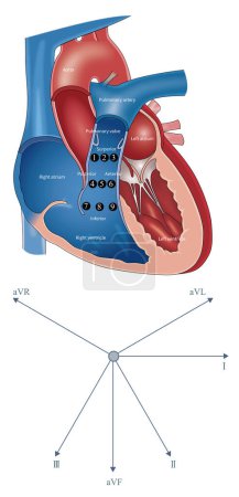 Photo for The figure shows the nine zones of the right ventricular outflow tract and the frontal hexaxial reference system. For VT from different regions, the QRS wave shape is some different. - Royalty Free Image
