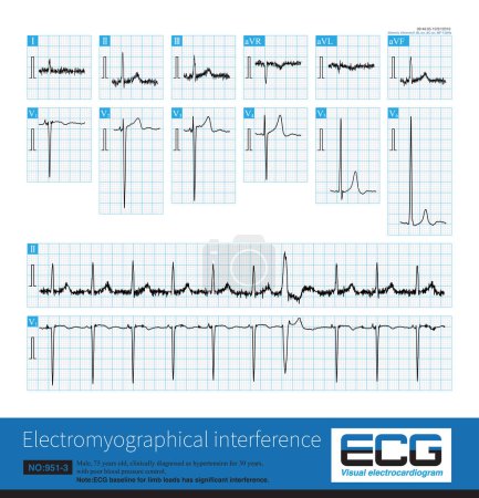 Téléchargez les photos : When the baseline of ECG is interfered by its own or external electrical signal, it will affect the shape and measured value of ECG wave, especially ST segment offset amplitude. - en image libre de droit