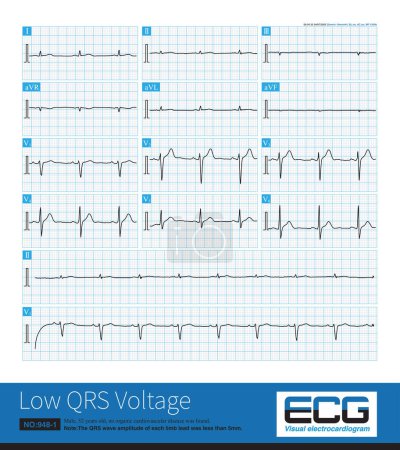 Téléchargez les photos : The QRS wave amplitude of each limb lead is less than 5mm, which is called limb lead low voltage. It can be seen in some physiological phenomena as well as organic heart disease. - en image libre de droit