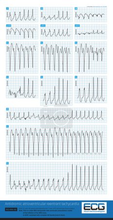 Téléchargez les photos : The QRS wave amplitude of each limb lead is less than 5mm, which is called limb lead low voltage. It can be seen in some physiological phenomena as well as organic heart disease. - en image libre de droit