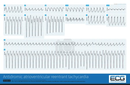 Photo for Atrioventricular accessory pathway is a cause of wide QRS tachycardia, and sometimes it is difficult to distinguish it from ventricular tachycardia, unless the ventricular preexcitation are typical. - Royalty Free Image