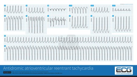 Téléchargez les photos : Atrioventricular accessory pathway is a cause of wide QRS tachycardia, and sometimes it is difficult to distinguish it from ventricular tachycardia, unless the ventricular preexcitation are typical. - en image libre de droit