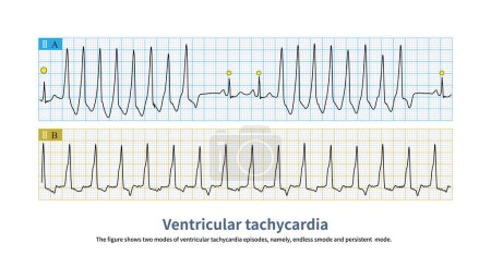 Foto de A is an endless pattern of ventricular tachycardia, and the yellow circle shows sinus heartbeat. B is a persistent pattern of ventricular tachycardia. - Imagen libre de derechos