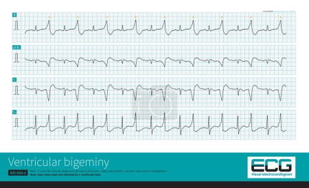 Téléchargez les photos : Some ventricular bigeminy are precursors of ventricular tachycardia, a sign of clinical deterioration and severe impairment of cardiac function, and predisposition to ventricular fibrillation and death. - en image libre de droit
