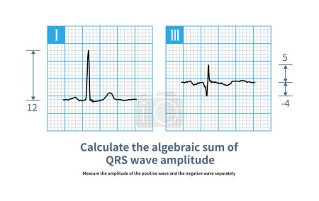 Téléchargez les photos : The calculation of algebraic sum of QRS wave is to measure the amplitude of positive wave (positive number) and negative wave (negative number) respectively, and then calculate the algebraic sum. - en image libre de droit