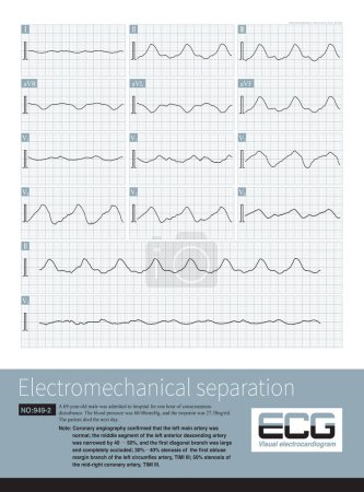 Photo for Electromechanical separation is a kind of terminal ECG. The patient's ECG has electrical signals, the ECG wave is widened with morphological abnormalities, and the ventricle has no contraction. - Royalty Free Image