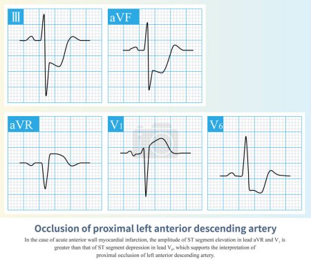 Photo for In the case of acute anterior myocardial infarction, the amplitude of ST segment offset can be used to deduce that the occlusive site is located in the proximal segment of the LAD. - Royalty Free Image