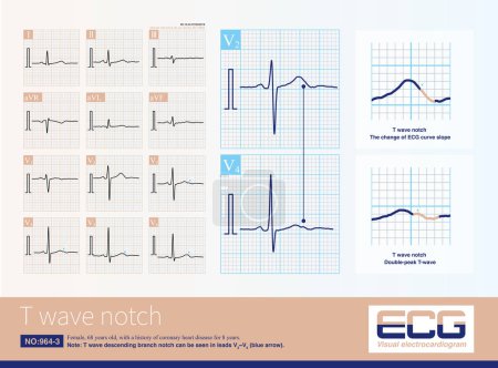 Téléchargez les photos : When the repolarization desynchronization difference between the left and right ventricles increases, T-wave notches appear on ECG, including physiologic and pathological causes. - en image libre de droit