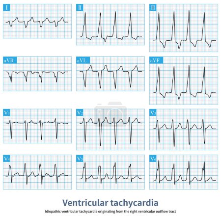 Photo for The patient's ventricular tachycardia has nothing to do with organic heart disease, and the arrhythmia originates from the right ventricular outflow tract. - Royalty Free Image