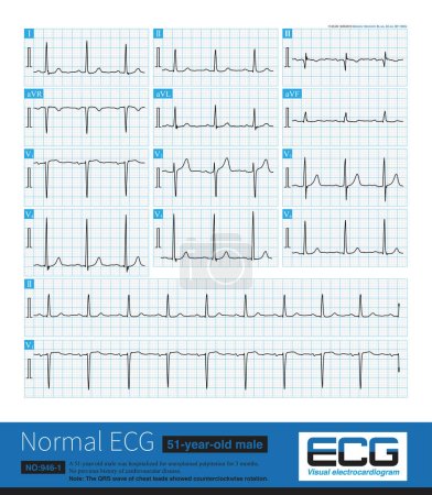 Photo for Note that the V3 lead of this ECG shows that the amplitude of R wave is greater than the amplitude of S wave, and there is counterclockwise rotation. - Royalty Free Image