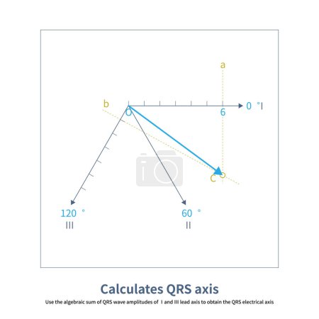 Téléchargez les photos : Marquer la somme algébrique des amplitudes QRS de plomb et sur l'axe de plomb, et la ligne d'extension des deux points se croise au point C. OC est l'axe électrique QRS. - en image libre de droit