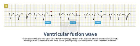 Foto de Durante la taquicardia ventricular, los latidos supraventriculares pueden formar diferentes grados de onda de fusión con latidos ventriculares, y la forma de onda QRS es variable.. - Imagen libre de derechos