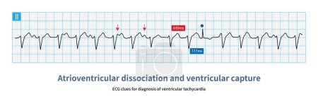 Photo for If atrioventricular dissociation and ventricular capture are found during wide QRS tachycardia, it supports the diagnosis of ventricular tachycardia with high specificity and poor sensitivity. - Royalty Free Image