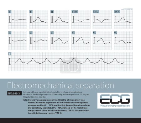 Téléchargez les photos : La séparation électromécanique est une sorte d'ECG terminal. L'ECG du patient a des signaux électriques, l'onde ECG est élargie avec des anomalies morphologiques, et le ventricule n'a pas de contraction. - en image libre de droit