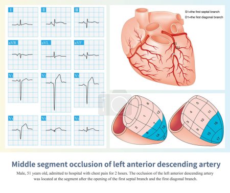 Foto de Cuando los segmentos medio-distales de la DA están ocluidos, también se generará el ECG de infarto de miocardio anterior extenso, pero el rango de infarto es menor que el de la oclusión alta.. - Imagen libre de derechos