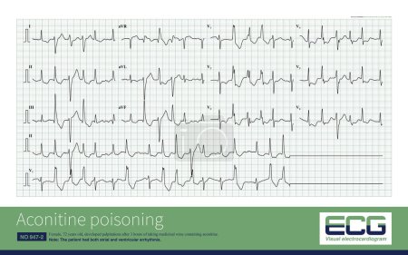 Photo for In aconitine poisoning, the atrium is inhibited, the amplitude of P wave decreases or atrial fibrillation occurs; ventricular triggering activity increased and ventricular arrhythmia occurred. - Royalty Free Image