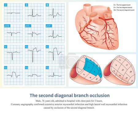 Téléchargez les photos : Lorsque la deuxième branche diagonale de la DAL est obstruée, elle provoque un infarctus du myocarde antérieur ventriculaire gauche localisé, mais parfois une élévation du segment ST des conduits I et aVL. - en image libre de droit