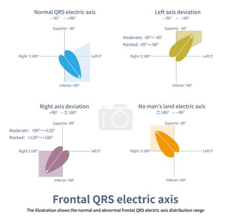 Téléchargez les photos : L'axe électrique QRS frontal est le potentiel moyen de la dépolarisation ventriculaire globale, et en raison de la masse ventriculaire gauche dominante, il est normalement orienté vers la gauche et inférieure. - en image libre de droit