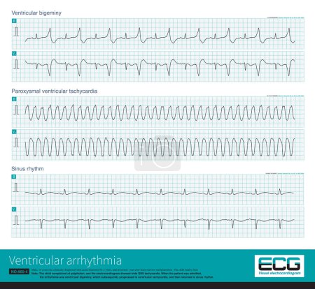 Photo for A 14-year-old leukemic child had a sudden wide QRS tachycardia with a frequency of 167 bpm, and the rhythm was regular. After anti-arrhythmia treatment, the patient recovered to sinus rhythm. - Royalty Free Image