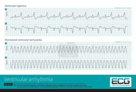 Photo for A 14-year-old leukemic child had a sudden wide QRS tachycardia with a frequency of 167 bpm, and the rhythm was regular. After anti-arrhythmia treatment, the patient recovered to sinus rhythm. - Royalty Free Image