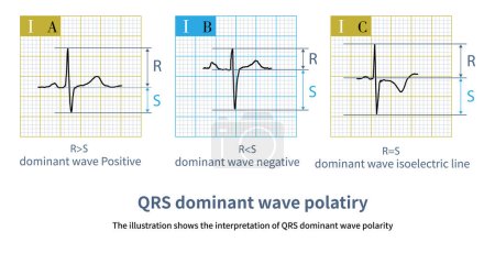 Photo for R wave greater than S wave is judged to be positive; R smaller than S  is judged to be negative; R equal to S amplitude is judged to be equipotential. - Royalty Free Image