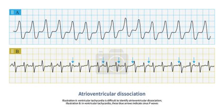 Téléchargez les photos : La dissociation auriculo-ventriculaire est un indice du diagnostic de la TVP. La flèche bleue montre l'onde sinus P, qui n'est pas reliée à l'onde QRS. Le diagnostic de tachycardie ventriculaire est clair. - en image libre de droit