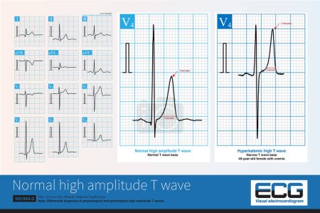 Photo for Healthy young and middle-aged men can exhibit normal high amplitude T waves ( beyond 10mm) and need to be differentiated from hyperkalemia T waves. - Royalty Free Image
