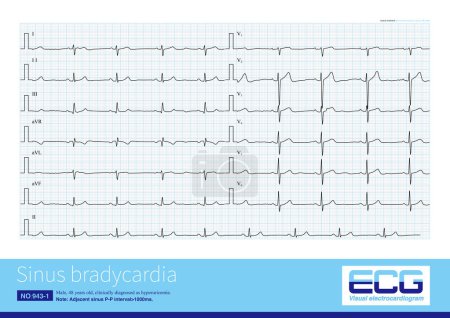 Généralement, lorsque la fréquence cardiaque sinusale est inférieure à 60 battements par minute, elle est appelée bradycardie sinusale. Cette arythmie peut être à la fois physiologique et souvent pathologique.