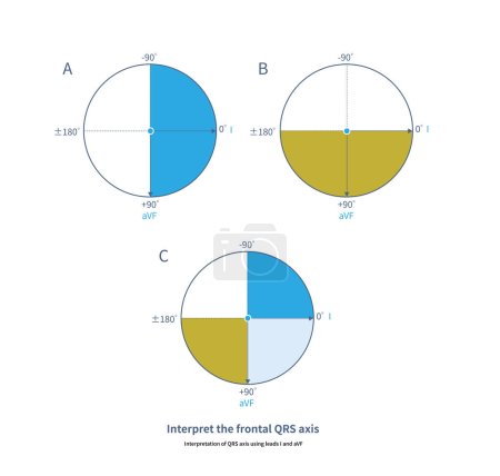 Téléchargez les photos : Les zones bleues et jaunes herbeuses représentent l'aire de répartition positive du SRQ pour le plomb I et l'aVF respectivement ; la zone bleu clair représente l'aire de répartition positive du SRQ pour le plomb I et l'aVF. - en image libre de droit