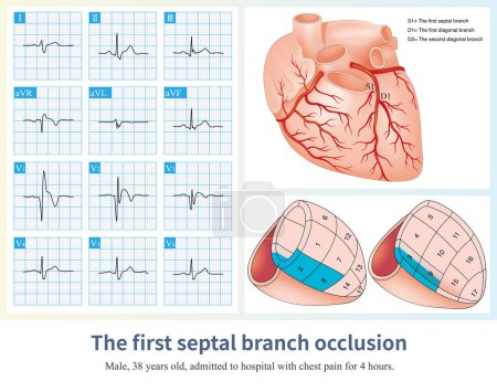 Photo for When isolated first septal branch occlusion occurs, it causes acute anteroseptal myocardial infarction and ST segment elevation in leads V1 to V2-V3. - Royalty Free Image