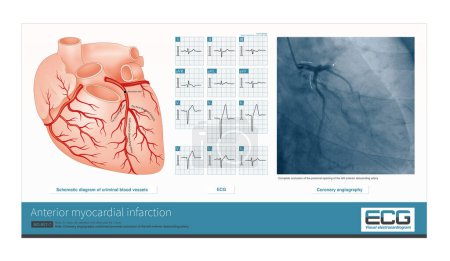 Photo for The proximal occlusion of the left anterior descending artery leads to a large area of anterior myocardial infarction, which belongs to the high occlusion of the left coronary artery. - Royalty Free Image