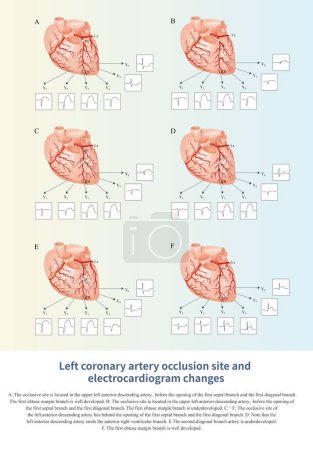 Photo for When different parts of the left coronary artery are occluded, it can lead to ST segment elevation or depression in different chest leads on the electrocardiogram. - Royalty Free Image