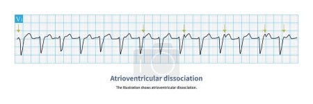 Photo for Atrioventricular separation is a clue to the diagnosis of ventricular tachycardia. The grass yellow arrow shows the sinus P wave, which is obviously not related to the QRS wave. - Royalty Free Image