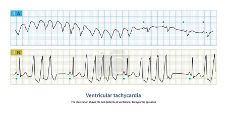 La ilustración muestra los dos patrones de taquicardia ventricular.El círculo verde representa el ritmo sinusal. La imagen A muestra episodios paroxísticos de taquicardia ventricular, y la imagen B muestra ráfagas cortas.