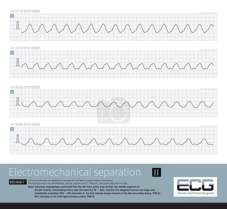 Photo for Electromechanical separation is a kind of terminal ECG. The patient's ECG has electrical signals, the ECG wave is widened with morphological abnormalities, and the ventricle has no contraction. - Royalty Free Image