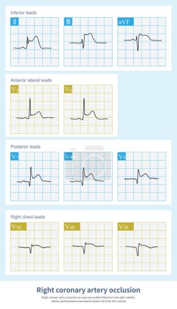 Photo for When right coronary artery occlusion occurs at different sites, it causes myocardial infarction at different sites and ST segment elevation in different leads. - Royalty Free Image