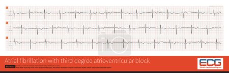 Photo for Cardiac surgery is one of the common causes of iatrogenic atrioventricular block. Once atrial fibrillation exhibits a slow and regular ventricular rhythm, it is important to be alert to 3 AVB. - Royalty Free Image