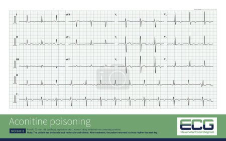 Photo for In aconitine poisoning, the atrium is inhibited, the amplitude of P wave decreases or atrial fibrillation occurs; ventricular triggering activity increased and ventricular arrhythmia occurred. - Royalty Free Image