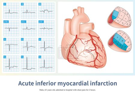 Téléchargez les photos : Lorsque l'ACR est occlus, il peut causer un infarctus aigu du myocarde inférieur, et l'amplitude de l'élévation du segment ST dans le plomb II est généralement supérieure à celle du plomb III.. - en image libre de droit