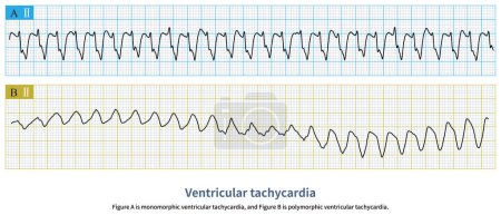 Foto de La morfología de la onda QRS de la taquicardia ventricular puede ser consistente, variable o incluso variante latido a latido. Este último tiene una hemodinámica más pobre y requiere tratamiento urgente.. - Imagen libre de derechos