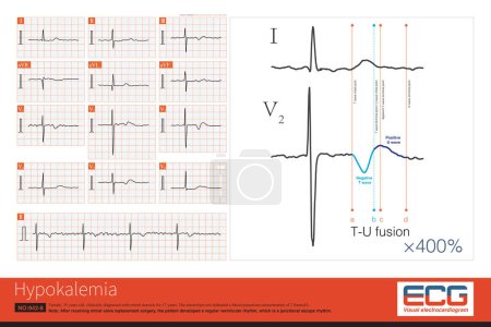 Photo for When hypokalemia occurs, the inverted T wave merges with the enlarged upright U wave, and should not be misdiagnosed as a negative positive biphasic T wave. - Royalty Free Image