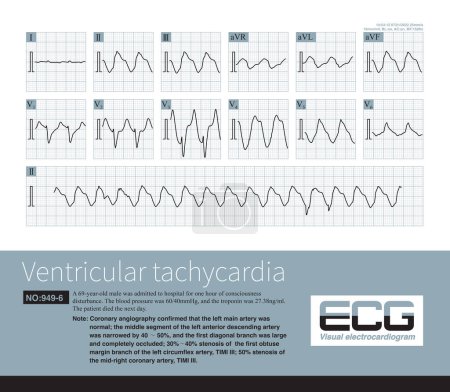 Photo for A 69 year old patient with acute anterior and inferior myocardial infarction developed a series of electrocardiograms of ventricular tachycardia, and ultimately died in the hospital. - Royalty Free Image